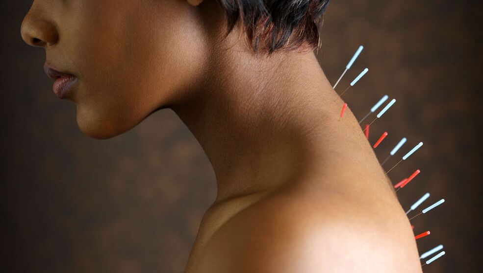 Акупунктура са остеохондрозом грлића материце