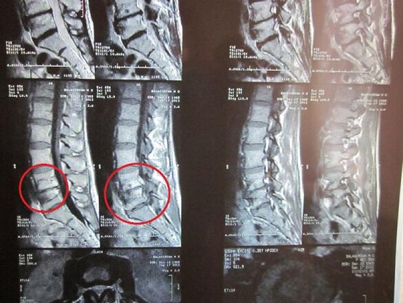 Дијагноза цервикалне остеохондрозе
