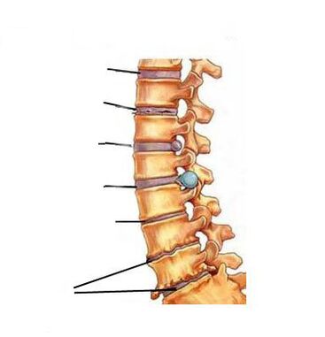 Како се развија остеохондроза