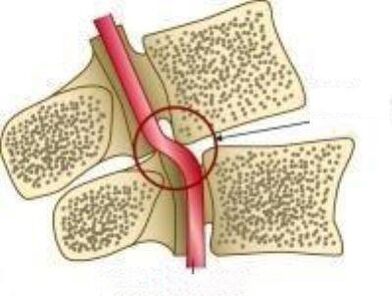 Синдром Ваил Артери
