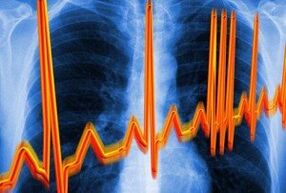 Срчана аритмија за остеохондрозу