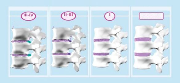 Фазе цервикалне остеохондрозе