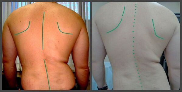 закривљеност кичме са остеохондрозом