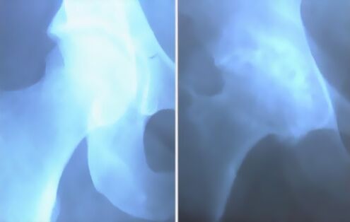 СЦУМ АРТРОЗА ЗЛОЧИНА КЛОЕ