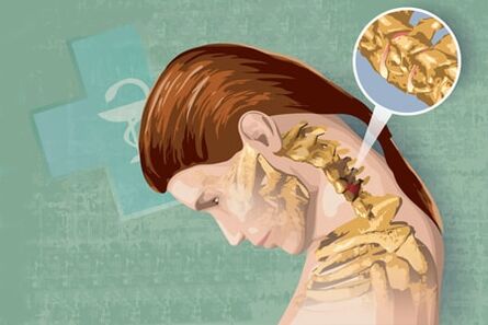 Рефлексни симптоми остеохондрозе